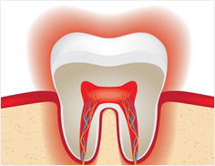 Sensitive Teeth