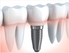 Dental Implants