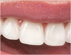 Porcelain Veneers