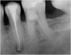 Root Canal