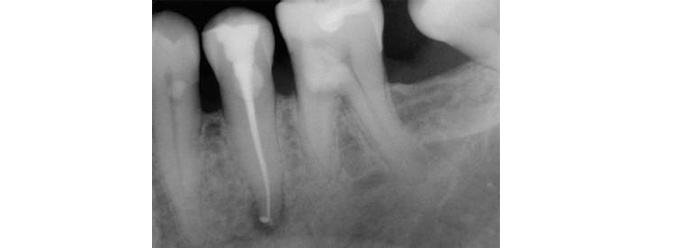 rootcanal