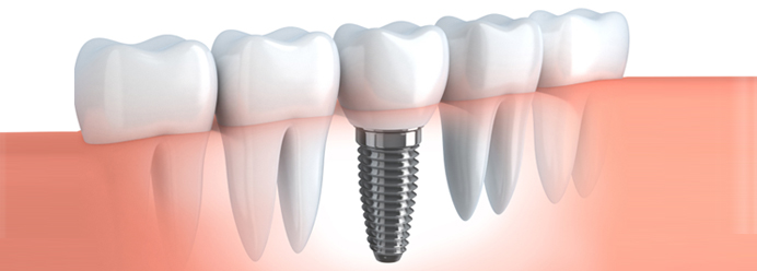 Dental-Implants-0111